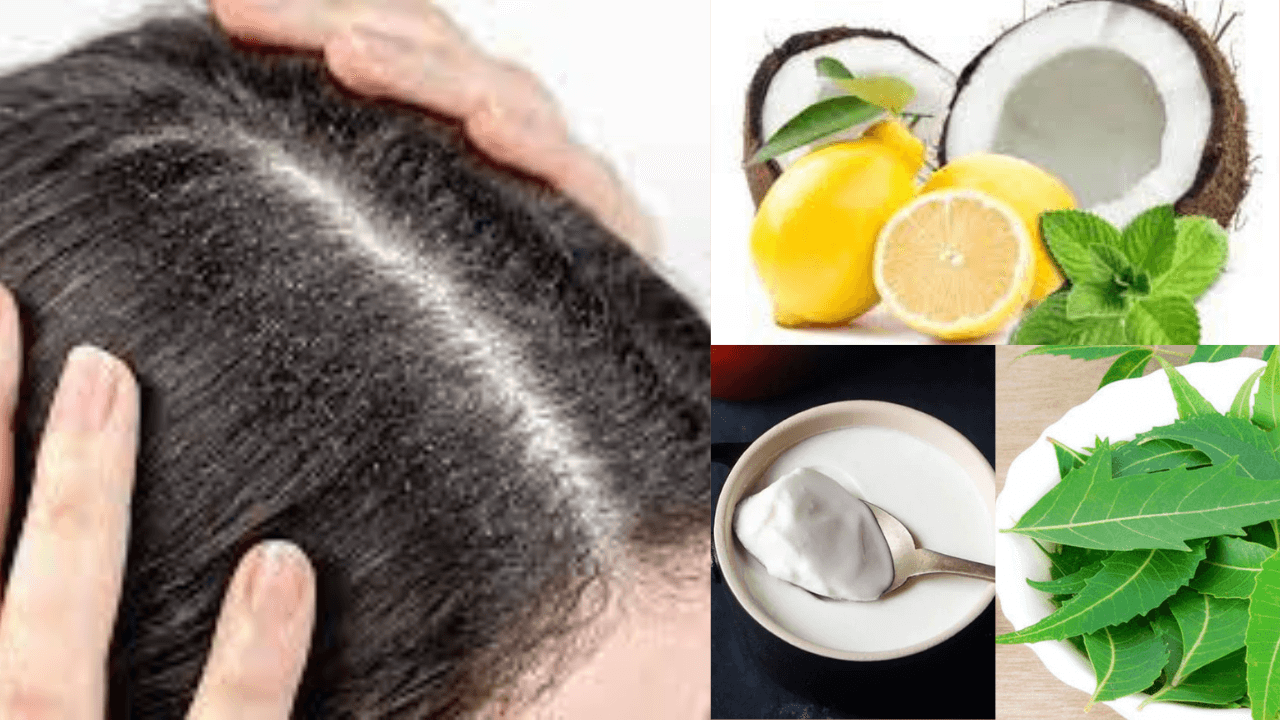 How to remove dandruff at home in Hindi