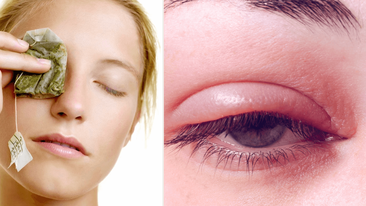 How to cure eye infection at home