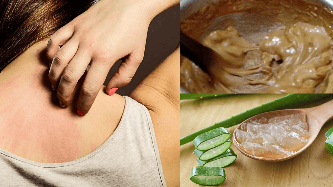 How to treat summer itching home remedy in hindi